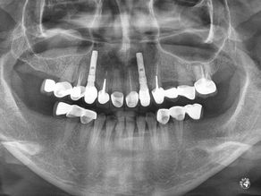 Implantation with GBR using CTi-membrane