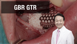 GBR with CTi-membrane in the narrow ridge in mandible