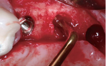 This procedure can be done in case of limited bone height (1-3mm).