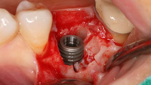 Immediate placement in the mandibular first molar
