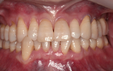  Frontal view of the prosthesis