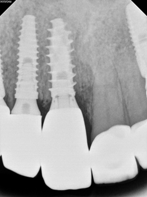 Final periapical radiograph