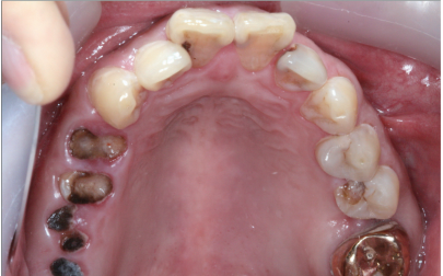 Occlusal Photograph