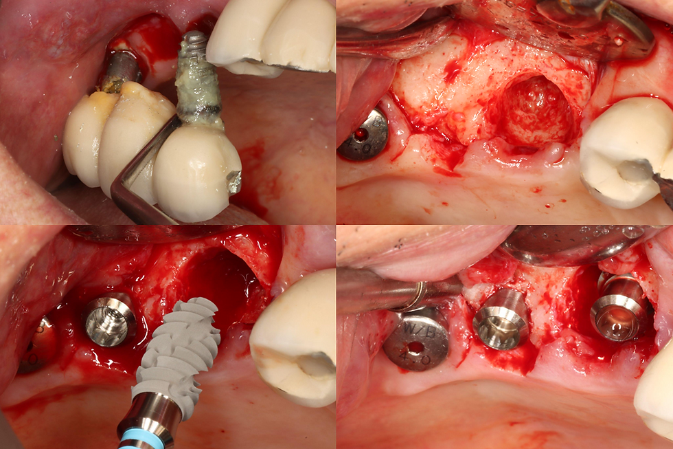 ALX Re-implantation after Explantation of Implant with Peri-implantitis