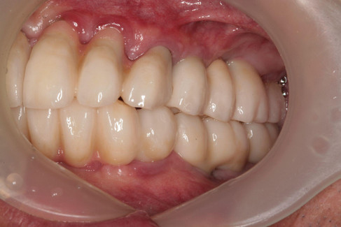 Right Lateral Intraoral View