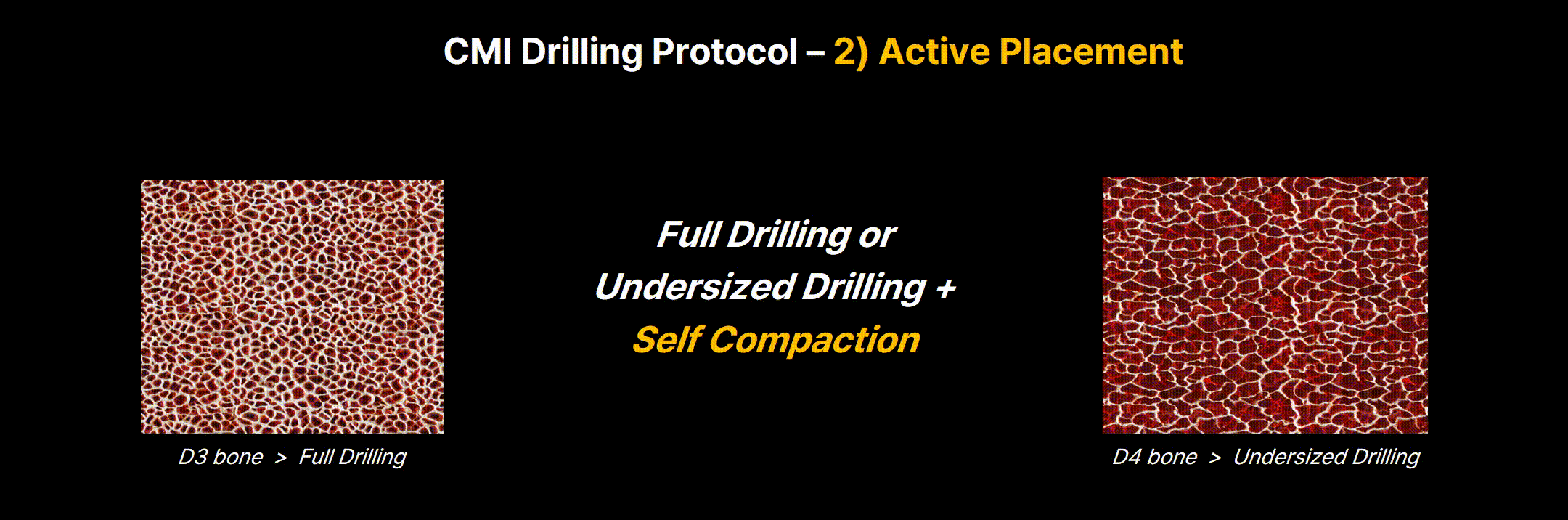 Active Placement for Soft Bone