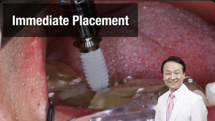 Immediate placement with VAROGuide #46