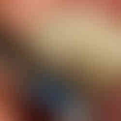 Implant, immediate placement, VAROGuide, Neobiotech, GAO, Bone graft, IP drill