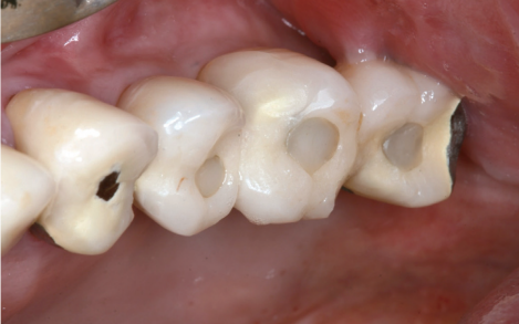 Occlusal view of the SCRP