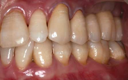 Buccal view of the prosthesis 