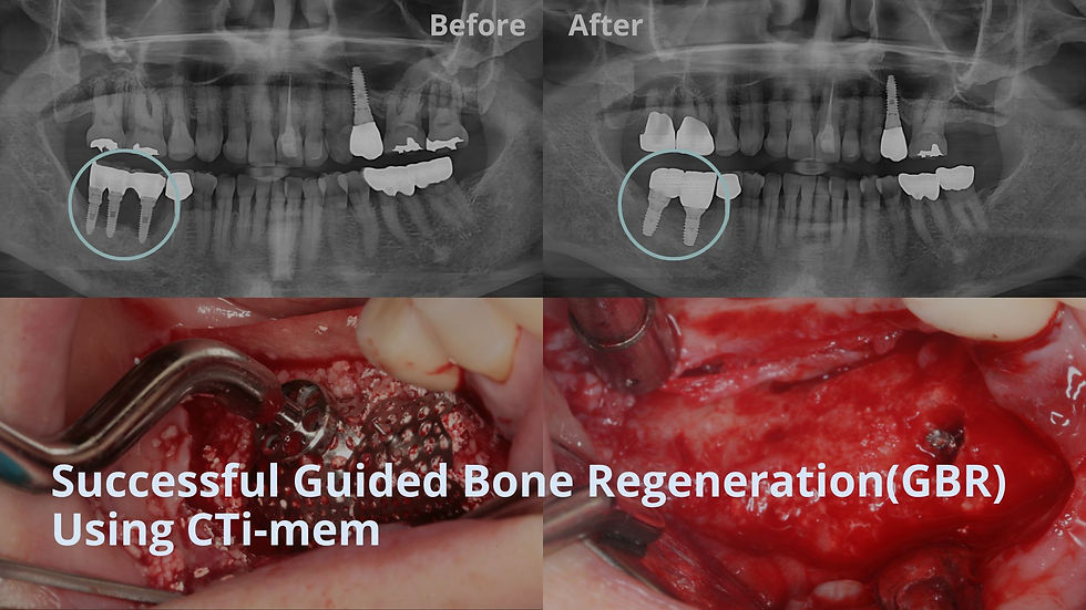 Successful Guided Bone Regeneration(GBR) Using CTi-mem