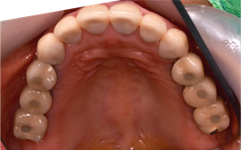 Maxillary occlusal view