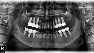 Panoramic radiograph