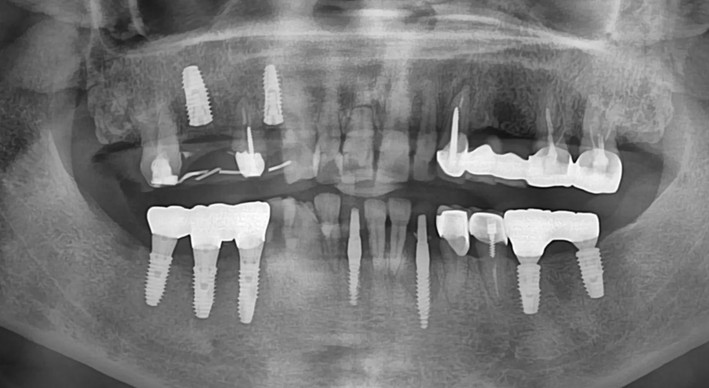 Post-operative radiographs shows well positioned implant.