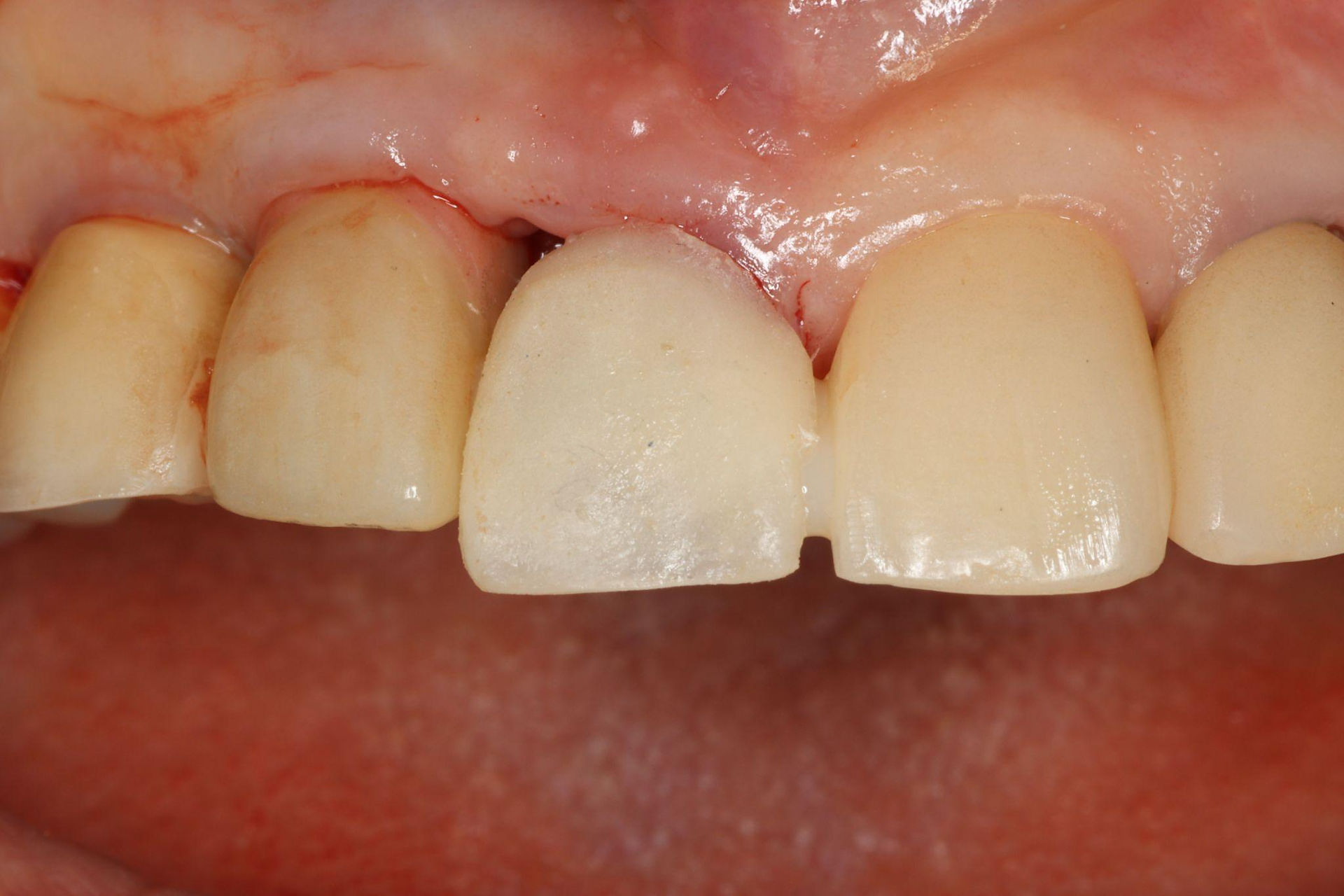 A provisional restoration was fabricated.