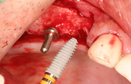 In the fully grafted site, four ∅5.0×13mm implants were successfully placed, as no residual bone remained. 