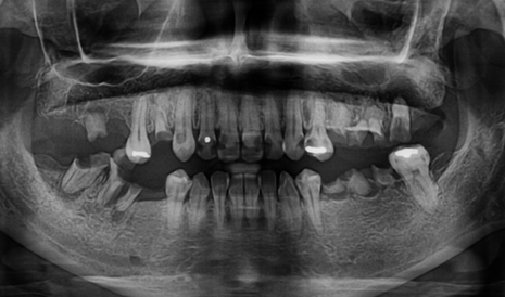 Pre-operative panoramic radiograph