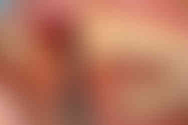 Final osteotomy performed with a ø3.5 twist drill in preparation for placement of ø4.5 ALX fixture.