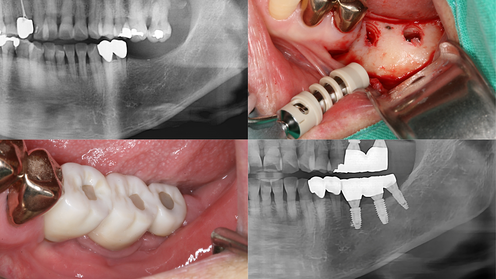 Posterior Mandibular Implant Case with Autogenous Bone Grafting and Long-term Follow-up