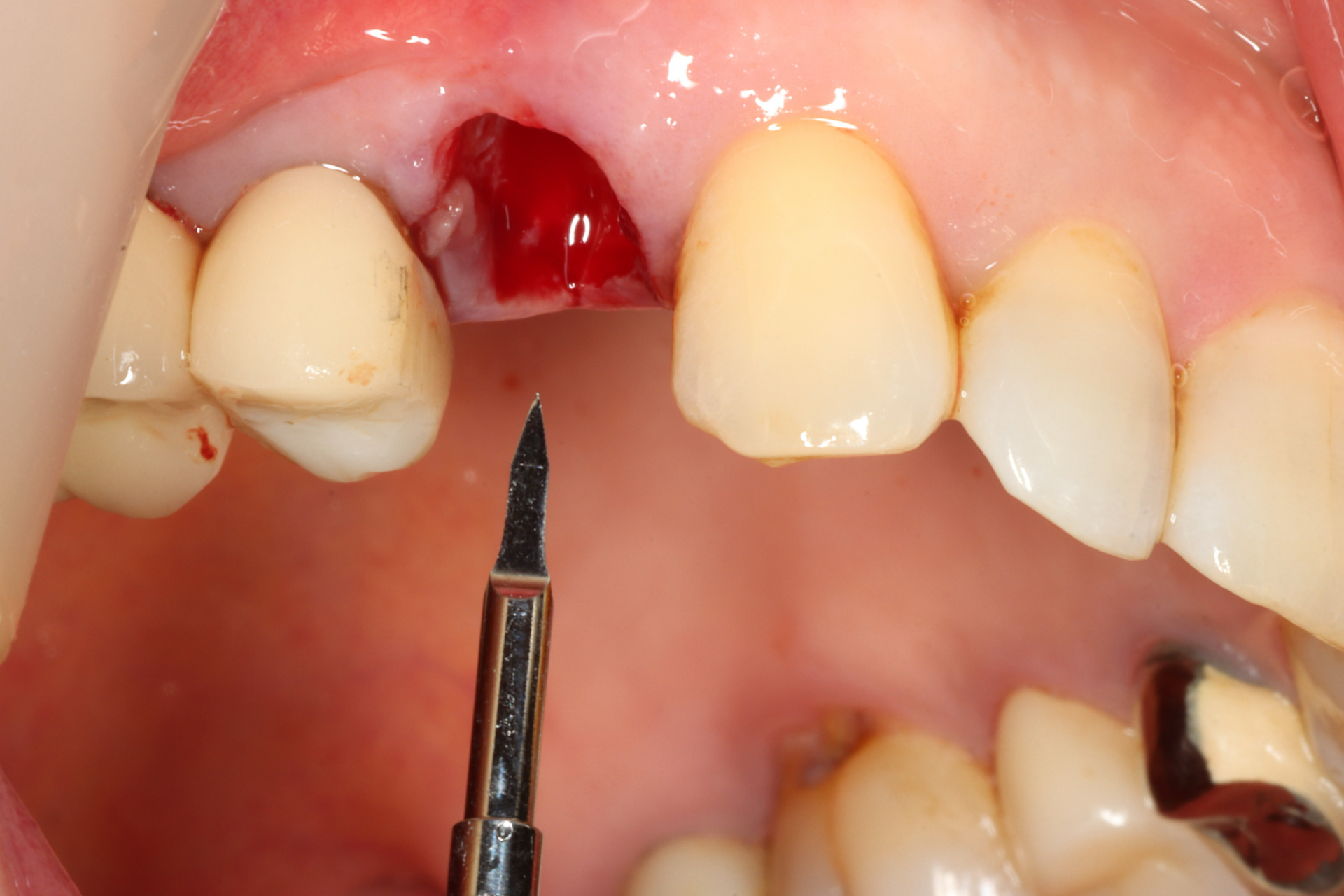 fig 1. After extraction, the implant position was determined with Point Initial drilling.