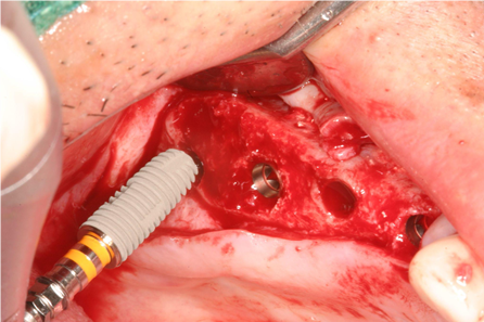 The lateral wall was completely filled with bone-like graft material, and an additional bone graft was performed at the apical area of implant #14 due to severe concavity.