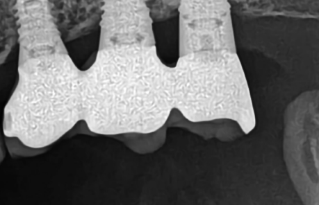 Periapical radiograph