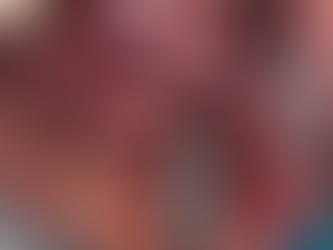 Implant placement with IT Wide Neck fixture in the Maxillary 1st Molar Area