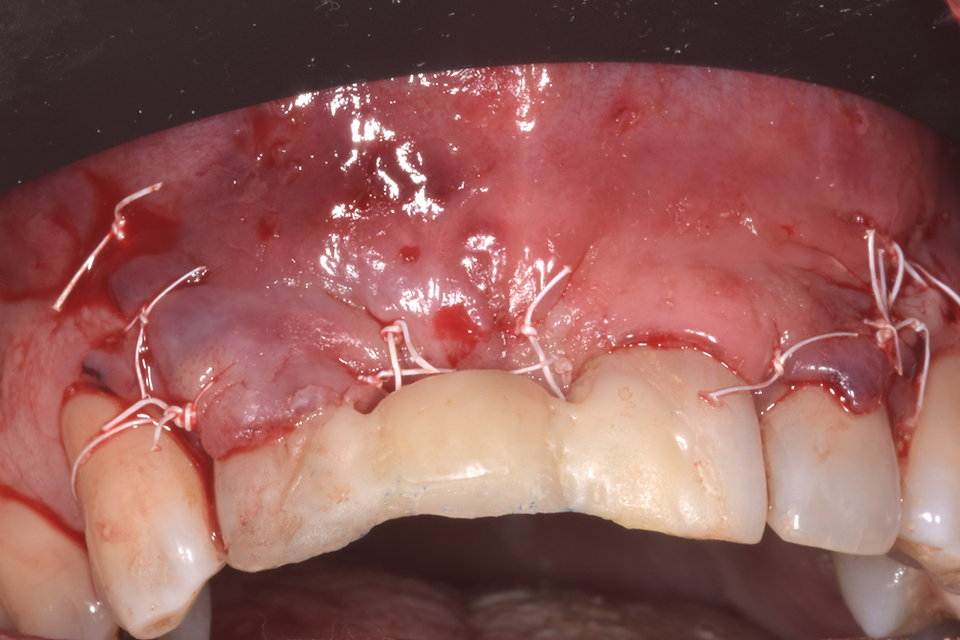 Primary closure was achieved without flap tension.