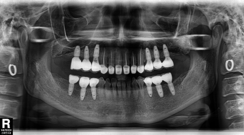 Before panoramic radiograph