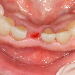 implant, lower anterior, VAROGuide, S-narrow, GAO, Neobiotech, IS3