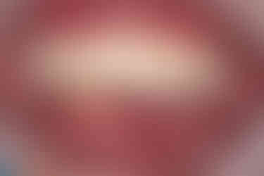 #43 exhibits severe mobility (Grade 3) and significant bone loss.