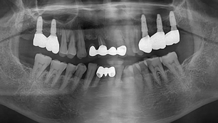 Maxillary sinus graft with lateral approach and implants placement at right upper molars with LS-rea