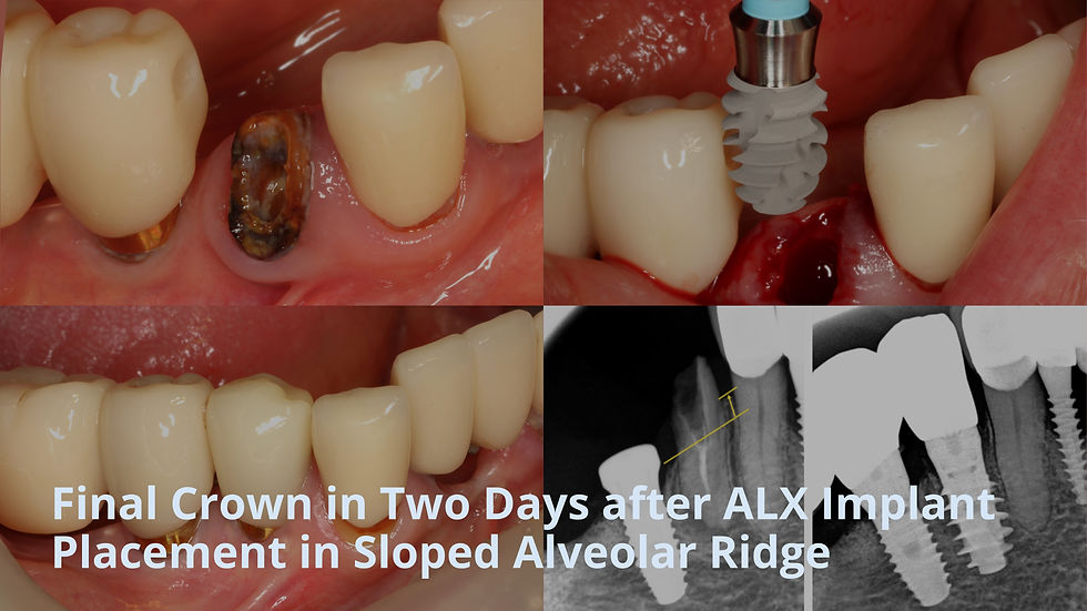 Final Crown in Two Days after ALX Implant Placement in Sloped Alveolar Ridge