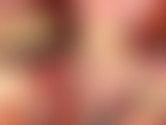 ALX Implant Placement with Lateral Sinus Approach in the Maxillary Posterior Area