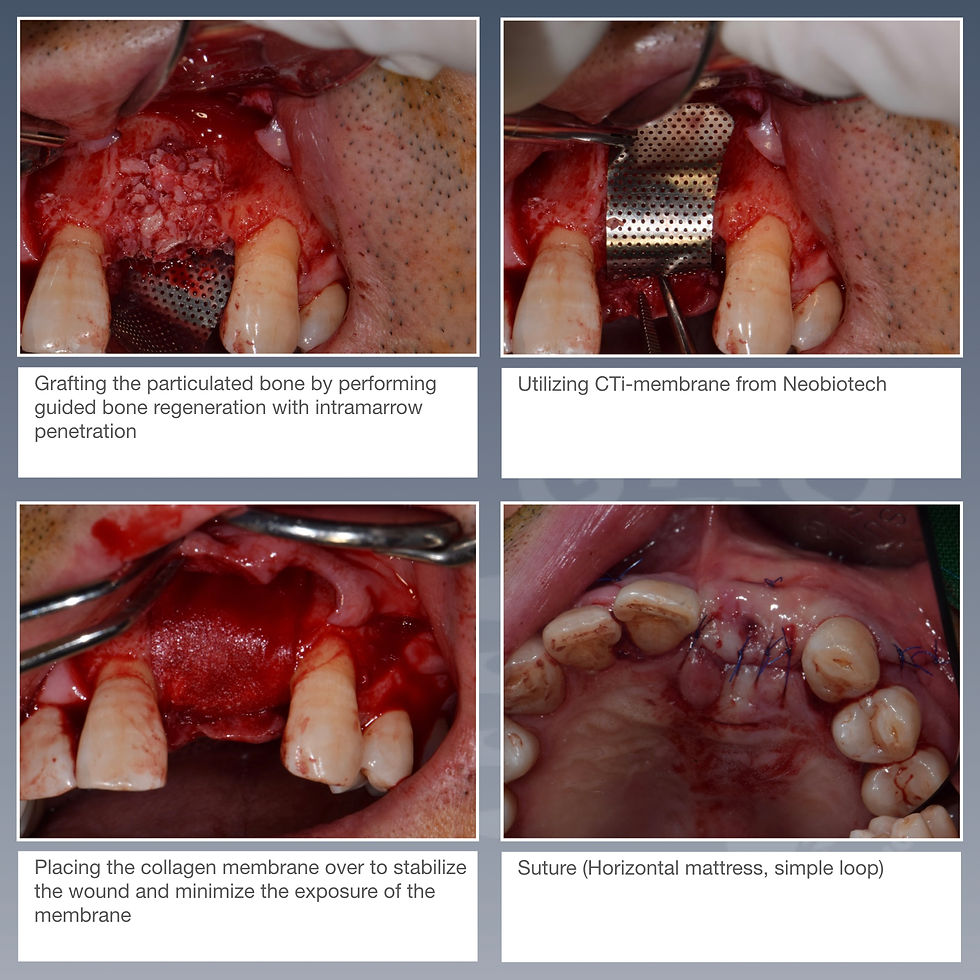 Neobiotech, Long term, Dental, Dental implant, implant, Implant case, GAO forum, GAO, Global Academy of Osseointegration, Dental Course, Implant course, Clinical case, GBR, Guided bone regeneration, Long term follow-up, Delayed implant placement