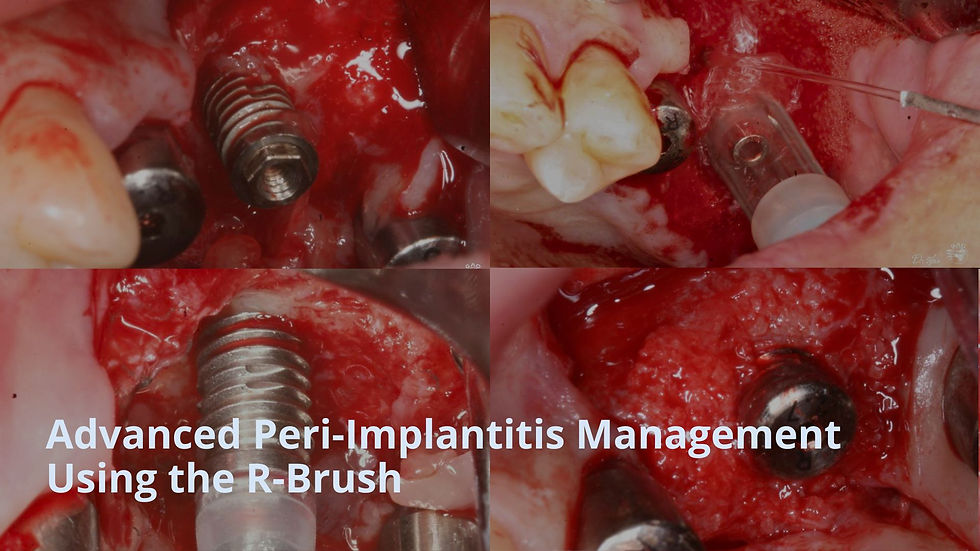 Advanced Peri-Implantitis Management Using the R-Brush