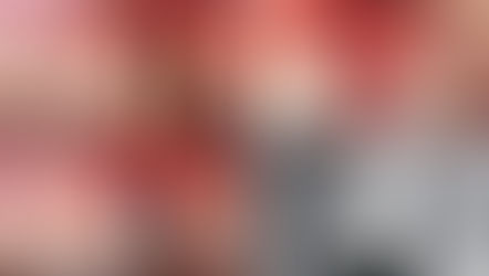 10mm Sinus Lifting with the SCA Technique in the Severely Concave Sinus Floor