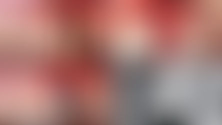 10mm Sinus Lifting with the SCA Technique in the Severely Concave Sinus Floor