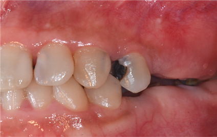 After implant placement