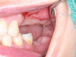 Simultaneous Implant Placement with C-reamer and Full Thickness Flap: 5 Year Follow-up