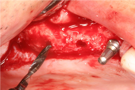 In the fully grafted site, four ∅5.0×13mm implants were successfully placed, as no residual bone remained. 