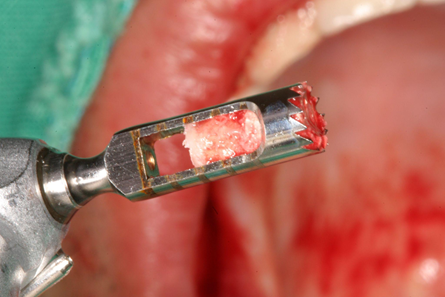 A trephine drill was used to harvest grafted bone from the third molar area (bone density: D3–2).