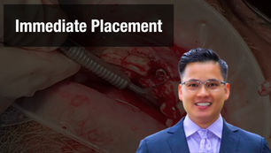 10(#22) Anterior Immediate Placement