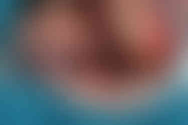 Through the lateral window, purulent sinus exudate was aspirated using a 10cc syringe, resulting in a syringe filled with discharge.