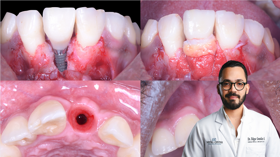 Aesthetic Rehabilitation in the Anterior Zone. Implant Placement and Inmediate Loading: Alveolar and Soft Tissue Reconstruction