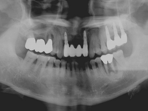 6 year Result of Simultaneous Implant Placement after Sinus Elevation through the Crestal Approach