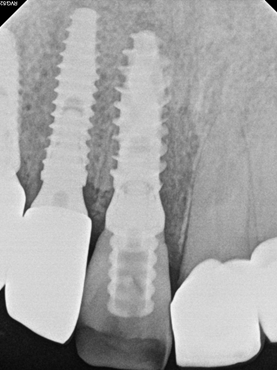 Periapical radiograph, 2 weeks after surgery