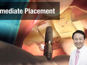 Immediate placement with VAROGuide #14