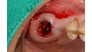 Immediate Placement with Sinus Class IV CM/C Fixation Using SLA Technique