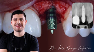 Replacing Removable Partial Prothesis with  an Implant-support Fixed Restoration